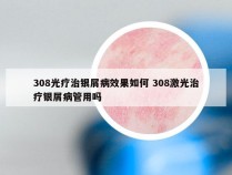 308光疗治银屑病效果如何 308激光治疗银屑病管用吗