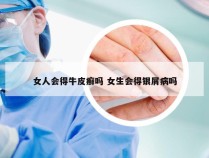 女人会得牛皮癣吗 女生会得银屑病吗