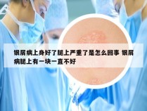 银屑病上身好了腿上严重了是怎么回事 银屑病腿上有一块一直不好