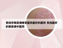 贵阳市银屑病哪家医院最好的医院 贵阳最好的银屑病中医院