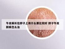 牛皮癣长在脖子上用什么要比较好 脖子牛皮肤癣怎么治