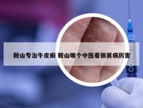 鞍山专治牛皮癣 鞍山哪个中医看银屑病厉害