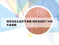 绿豆汤怎么治疗牛皮癣 绿豆汤治好了30年牛皮顽癣