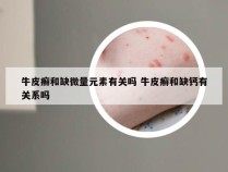 牛皮癣和缺微量元素有关吗 牛皮癣和缺钙有关系吗