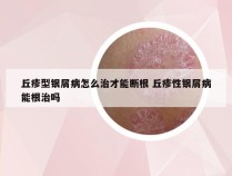 丘疹型银屑病怎么治才能断根 丘疹性银屑病能根治吗