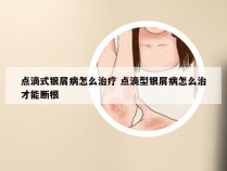 点滴式银屑病怎么治疗 点滴型银屑病怎么治才能断根