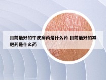 目前最好的牛皮癣药是什么药 目前最好的减肥药是什么药