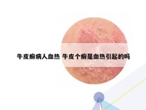 牛皮癣病人血热 牛皮个癣是血热引起的吗