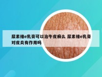 尿素维e乳膏可以治牛皮癣么 尿素维e乳膏对皮炎有作用吗