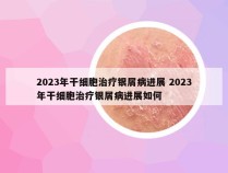 2023年干细胞治疗银屑病进展 2023年干细胞治疗银屑病进展如何