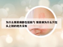 为什么银屑病都在后脑勺 银屑病为什么只在头上别的地方没有