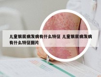 儿童银屑病发病有什么特征 儿童银屑病发病有什么特征图片