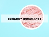 银屑病长脸部了 银屑病长脸上严重不