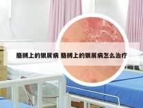 胳膊上的银屑病 胳膊上的银屑病怎么治疗
