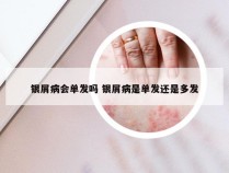银屑病会单发吗 银屑病是单发还是多发
