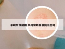 单纯型银屑病 单纯型银屑病能治愈吗
