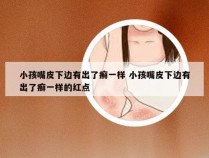 小孩嘴皮下边有出了癣一样 小孩嘴皮下边有出了癣一样的红点