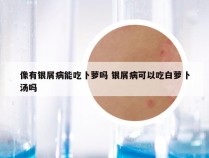 像有银屑病能吃卜萝吗 银屑病可以吃白萝卜汤吗