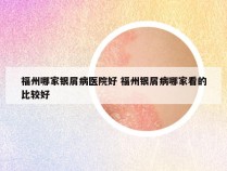 福州哪家银屑病医院好 福州银屑病哪家看的比较好