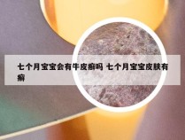 七个月宝宝会有牛皮癣吗 七个月宝宝皮肤有癣