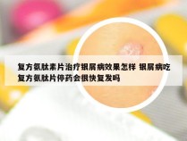 复方氨肽素片治疗银屑病效果怎样 银屑病吃复方氨肽片停药会很快复发吗