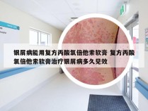 银屑病能用复方丙酸氯倍他索软膏 复方丙酸氯倍他索软膏治疗银屑病多久见效