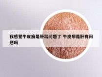 我感觉牛皮癣是肝出问题了 牛皮癣是肝有问题吗