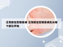 泛发脓包型银屑病 泛发脓包型银屑病先从哪个部位开始