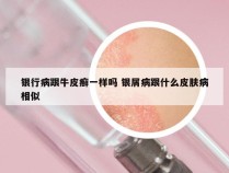 银行病跟牛皮癣一样吗 银屑病跟什么皮肤病相似