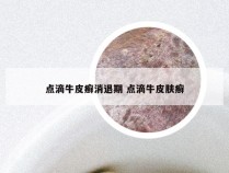 点滴牛皮癣消退期 点滴牛皮肤癣