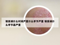 银屑病什么时候严重什么季节严重 银屑病什么季节最严重