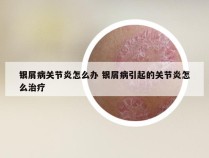 银屑病关节炎怎么办 银屑病引起的关节炎怎么治疗