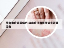 放血治疗银屑病吧 放血疗法治银屑病有效果没有