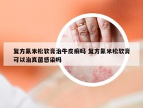 复方氟米松软膏治牛皮癣吗 复方氟米松软膏可以治真菌感染吗