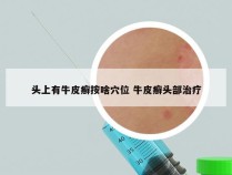 头上有牛皮癣按啥穴位 牛皮癣头部治疗