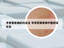 寻常银屑病的内治法 寻常型银屑病中医辨证论治
