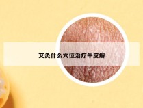 艾灸什么穴位治疗牛皮癣
