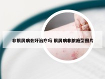 非银屑病会好治疗吗 银屑病非脓疱型图片