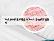 牛皮癣穿的是不是遗传下一代 牛皮癣要遗传吗