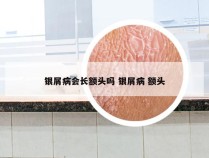 银屑病会长额头吗 银屑病 额头