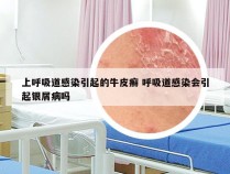 上呼吸道感染引起的牛皮癣 呼吸道感染会引起银屑病吗