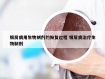 银屑病用生物制剂的恢复过程 银屑病治疗生物制剂