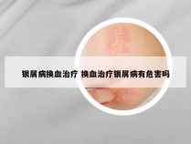 银屑病换血治疗 换血治疗银屑病有危害吗