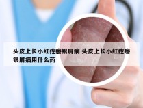 头皮上长小红疙瘩银屑病 头皮上长小红疙瘩银屑病用什么药
