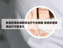 脓疱型银屑病割耳治疗牛皮癣图 脓疱型银屑病治疗大概多久