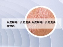 头皮癣用什么药洗头 头皮癣用什么药洗头 特效药