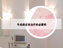 牛皮癣还有治疗的必要吗