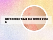银屑病瘙痒难耐怎么办 银屑病痒得难受怎么办