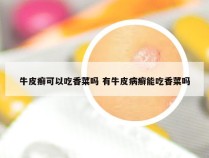 牛皮癣可以吃香菜吗 有牛皮病癣能吃香菜吗