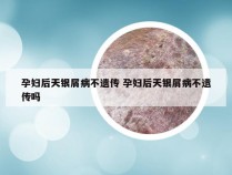 孕妇后天银屑病不遗传 孕妇后天银屑病不遗传吗